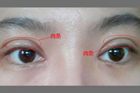 雙眼皮失敗了怎么辦？<a href='/zz/' target='_blank'><u>鄭州美萊</u></a>醫院助你重獲新生