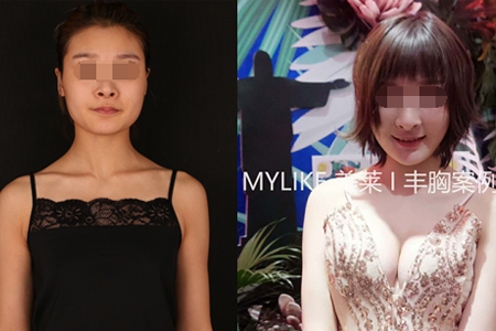 <a href='/zz/' target='_blank'><u>鄭州美萊</u></a>整形假體豐胸和自體豐胸哪個好？