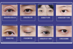 鄭州美萊雙眼皮修復為什么比割雙眼皮貴？