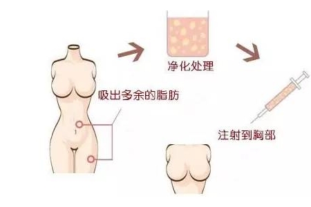 曲靖自體脂肪豐胸維持多久？有哪些優點