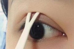 雙眼皮手術(shù)方法有幾種，術(shù)后注意事項有哪些