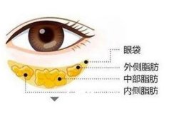 貴陽醫院祛眼袋一般多少錢，效果可以維持多久